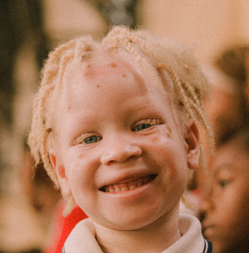 African Albino